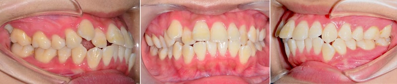 台中患者在暴牙矯正前各角度的牙齒咬合近照，有骨暴、牙齒亂、牙齒擁擠等問題