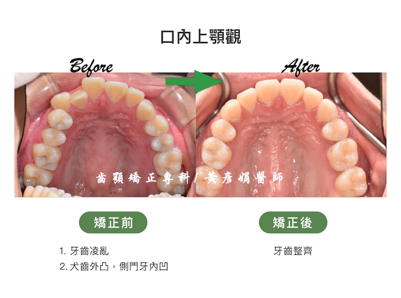 台中患者暴牙矯正前後的口內上顎觀比較：矯正前牙齒擁擠凌亂，且右側犬齒外凸、側門牙內凹；矯正後牙齒整齊