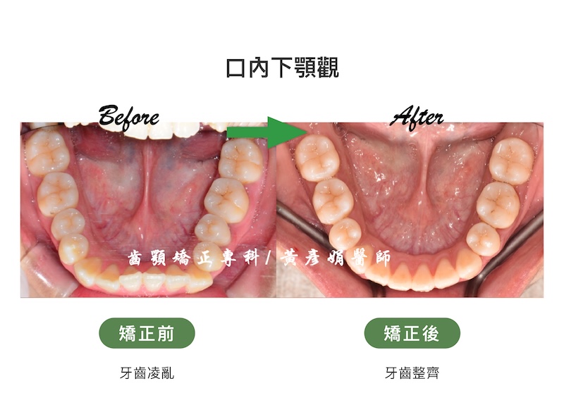 台中患者暴牙矯正前後的口內下顎觀比較：矯正前牙齒亂；矯正後牙齒整齊
