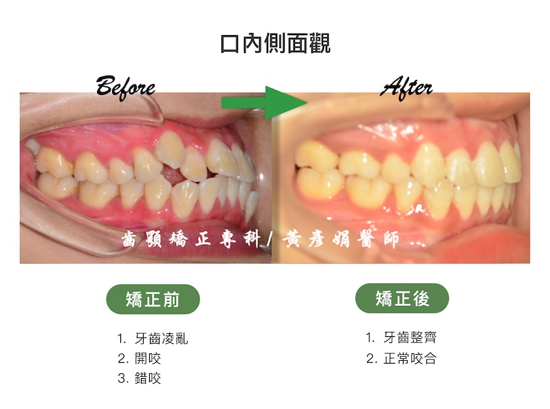 台中患者暴牙矯正前後的口內側面觀比較：矯正前牙齒亂，並伴隨開咬、錯咬；矯正後牙齒整齊，恢復正常咬合