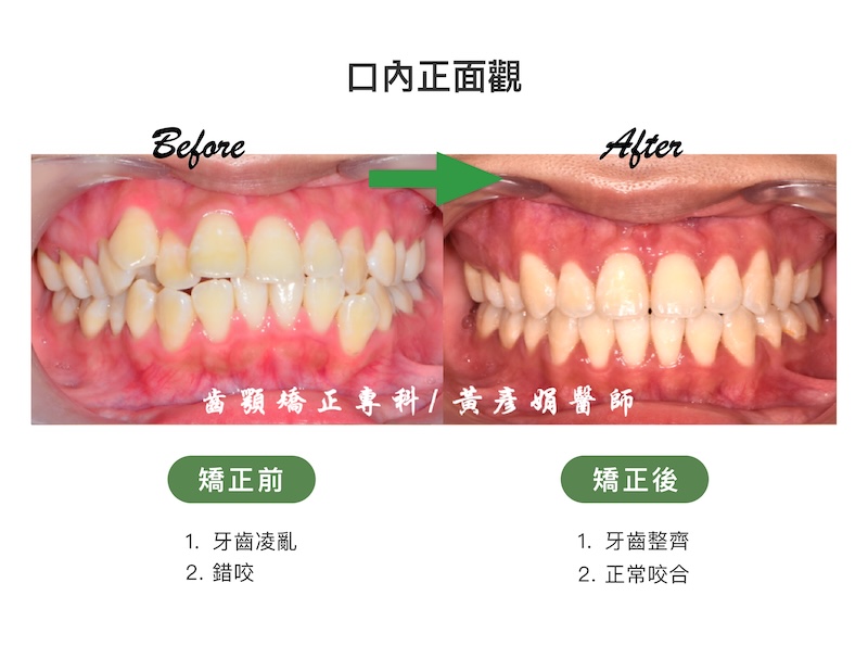 台中患者暴牙矯正前後的口內正面觀比較：矯正前牙齒凌亂、錯咬；矯正後牙齒整齊，恢復正常咬合