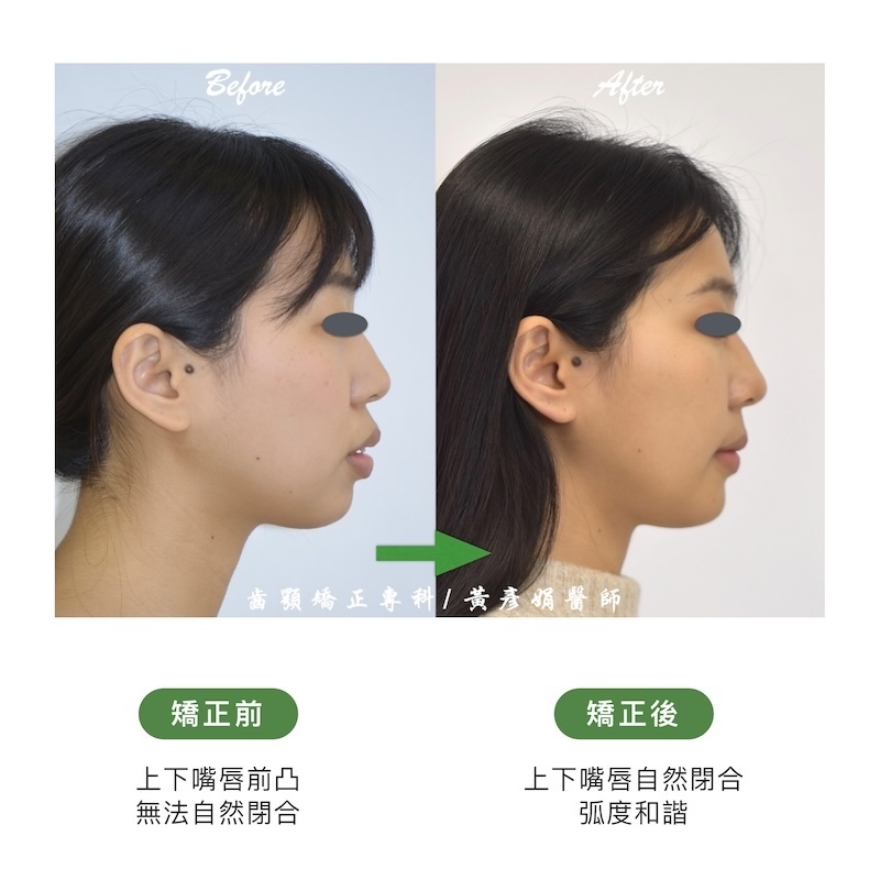 台中患者暴牙矯正前後的側面臉型外觀比較：矯正前上下嘴唇前凸，無法自然閉合；矯正後上下嘴唇自然閉合，弧度和諧