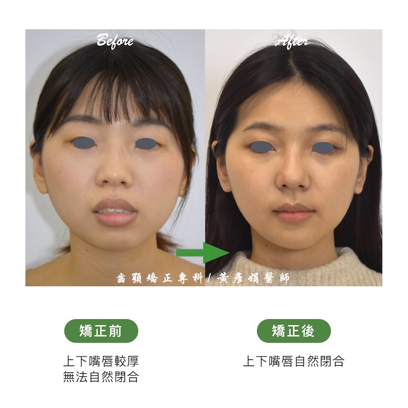台中患者暴牙矯正前後的正面臉型外觀比較：矯正前上下嘴唇較厚，無法自然閉合；矯正後嘴唇自然閉合