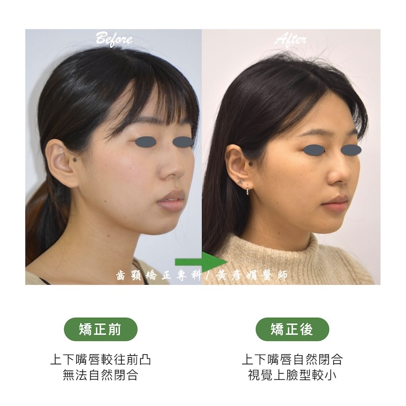 台中患者暴牙矯正前後的臉型外觀比較：矯正前上下嘴唇較往前凸；矯正後上下嘴唇自然閉合，視覺上臉型變小