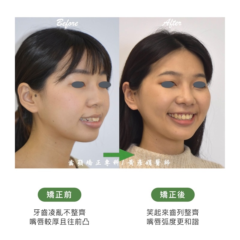 台中患者暴牙矯正前後的臉型外觀比較：矯正前牙齒亂、嘴唇較厚往前凸；矯正後齒列整齊，嘴唇弧度更和諧
