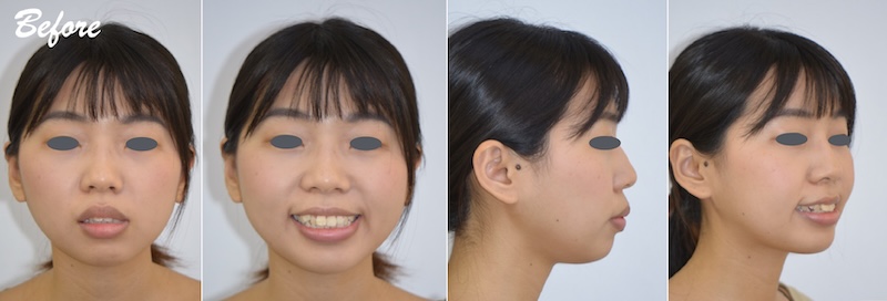 台中患者在暴牙矯正前的各角度的臉型外觀，因骨暴導致嘴唇閉不起來，伴隨牙齒亂、牙齒擁擠，虎牙不對稱等問題